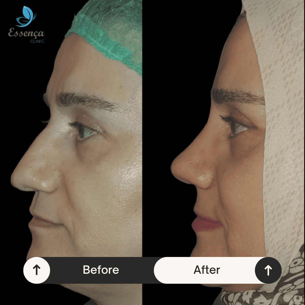 Nose Surgery - Rhinoplasty (13)