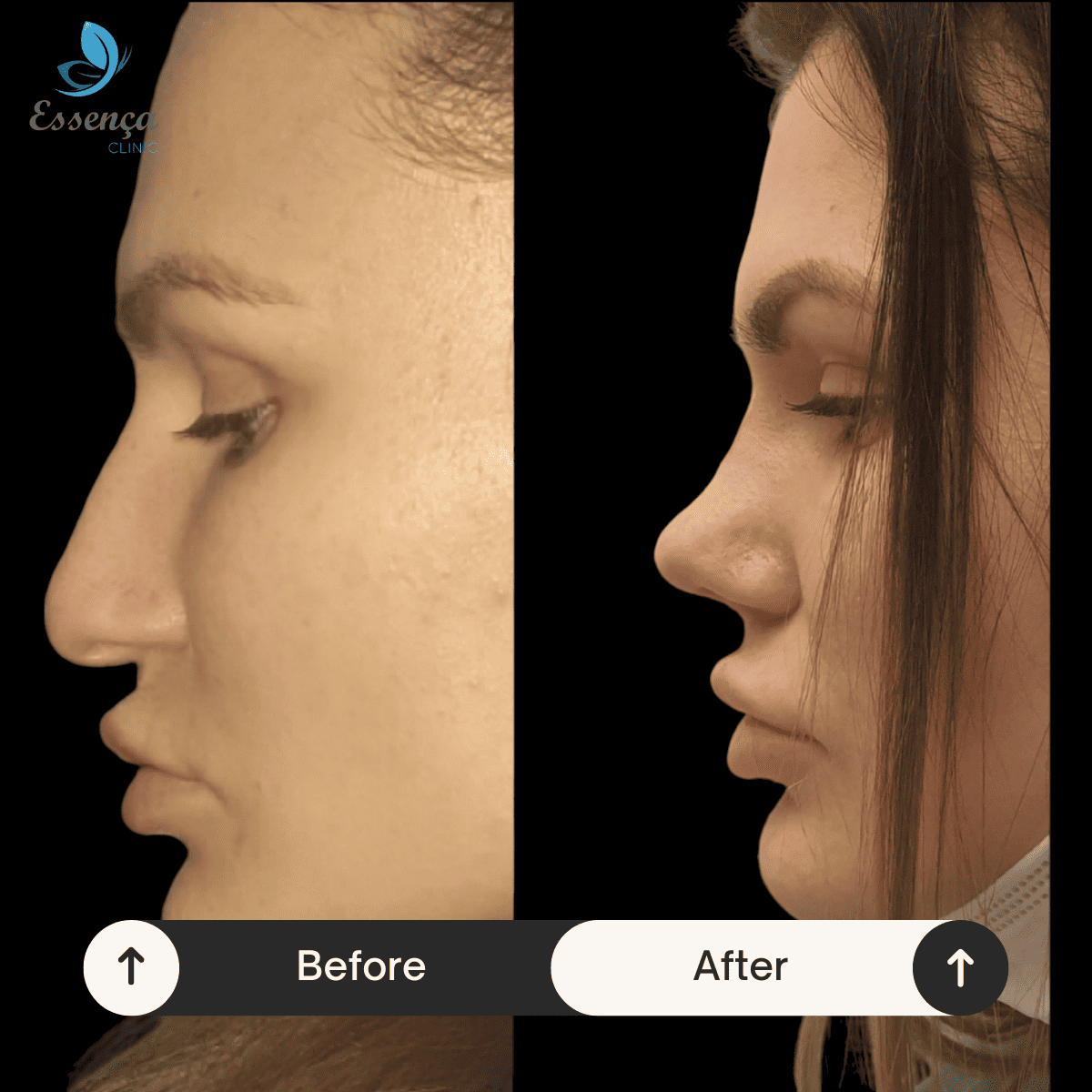Nose Surgery - Rhinoplasty (14)