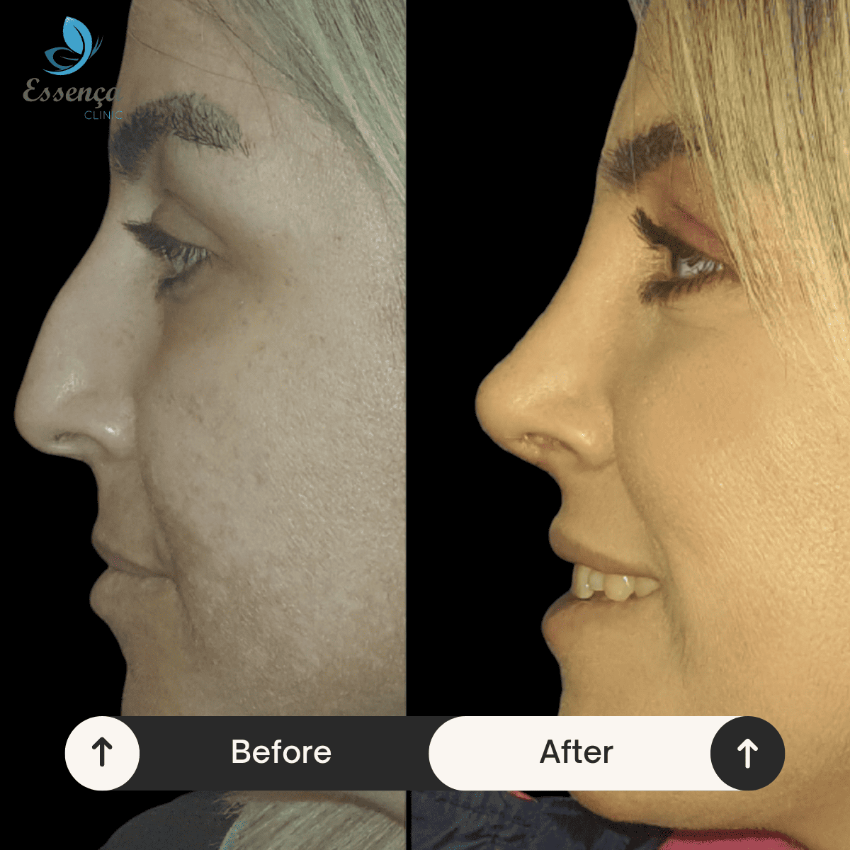 Nose Surgery - Rhinoplasty (15)