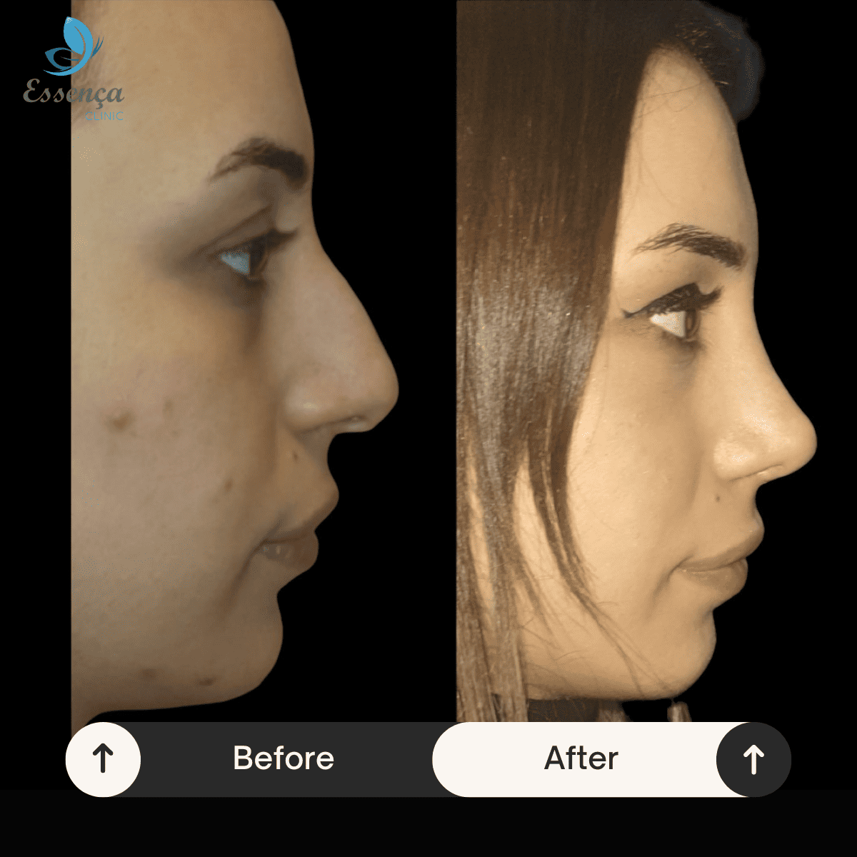 Nose Surgery - Rhinoplasty (16)