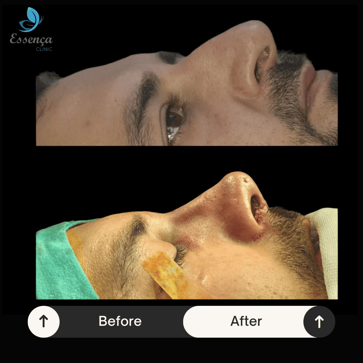 Nose Surgery - Rhinoplasty (17)