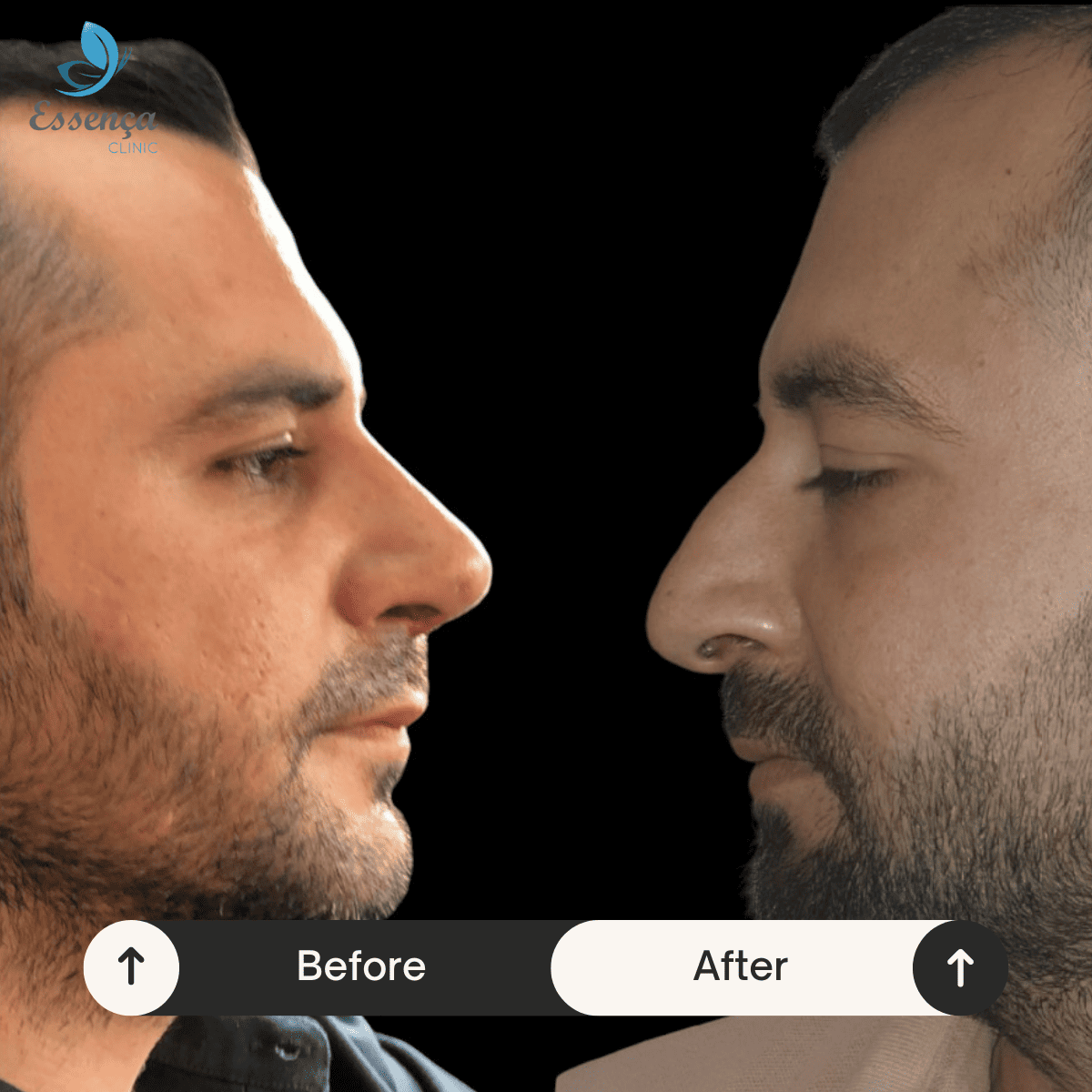Nose Surgery - Rhinoplasty (18)