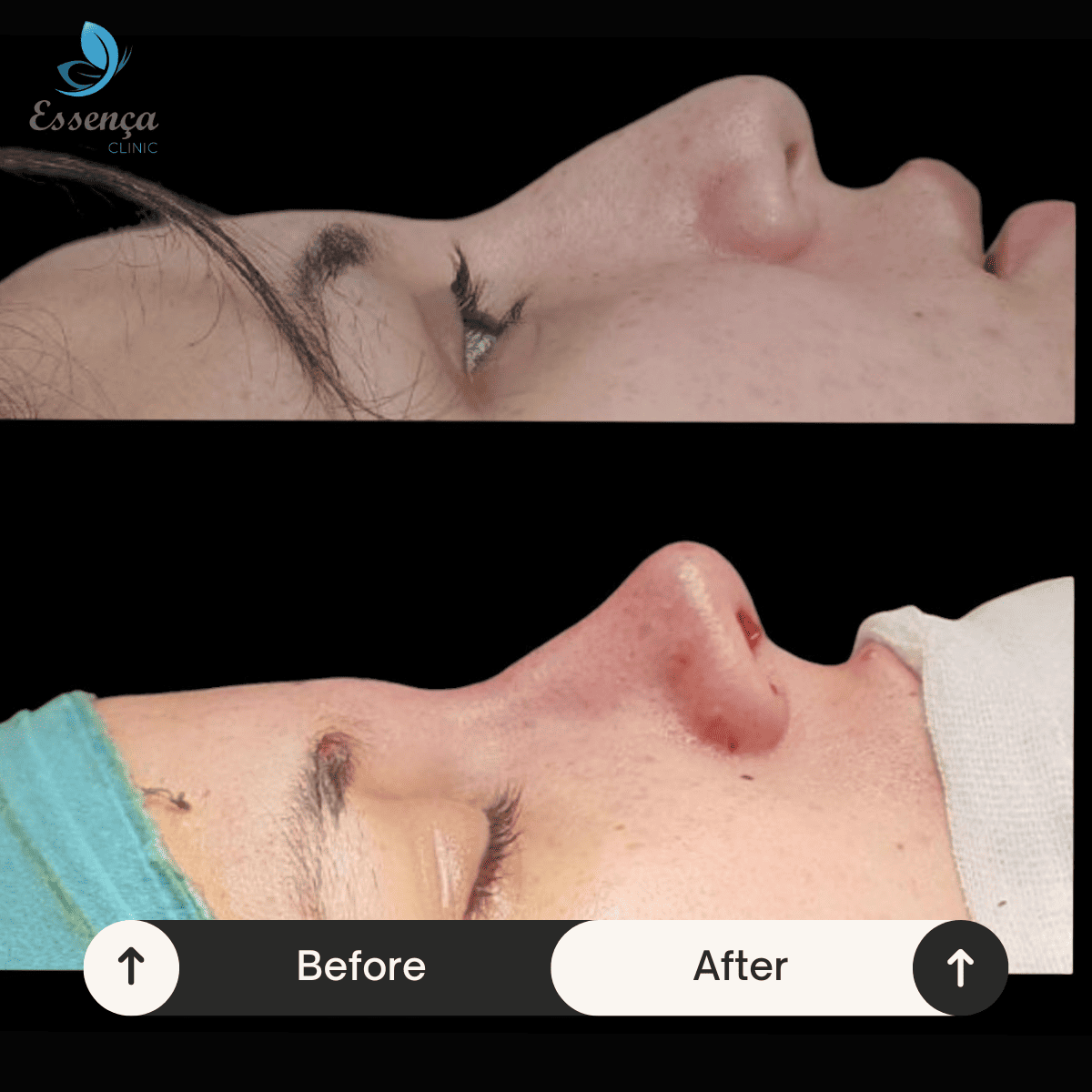 Nose Surgery - Rhinoplasty (19)