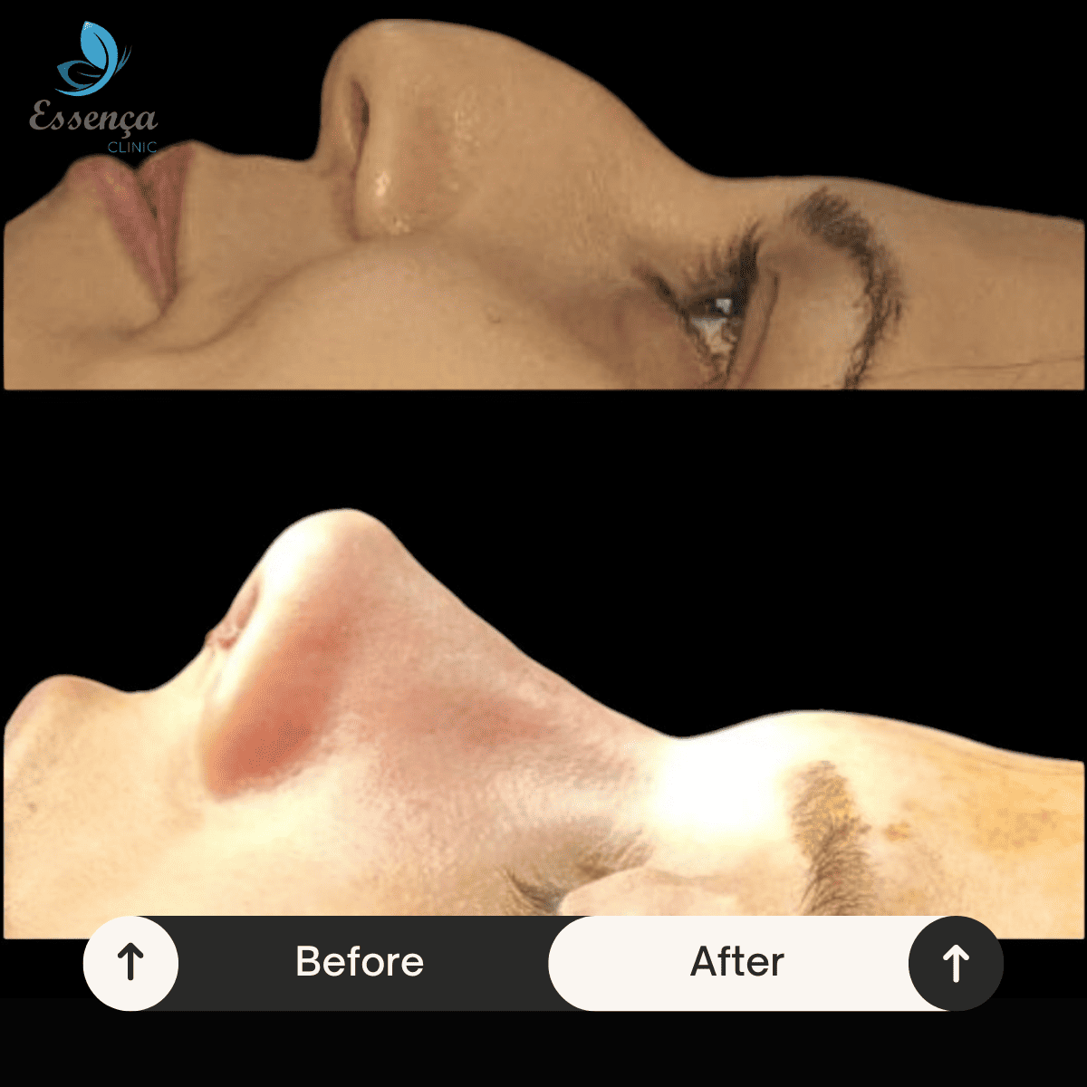 Nose Surgery - Rhinoplasty (20)