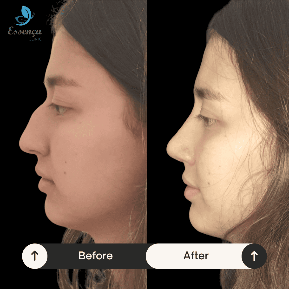 Nose Surgery - Rhinoplasty (21)
