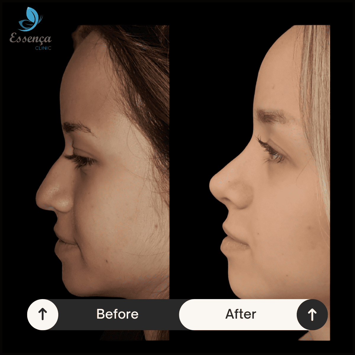 Nose Surgery - Rhinoplasty (22)