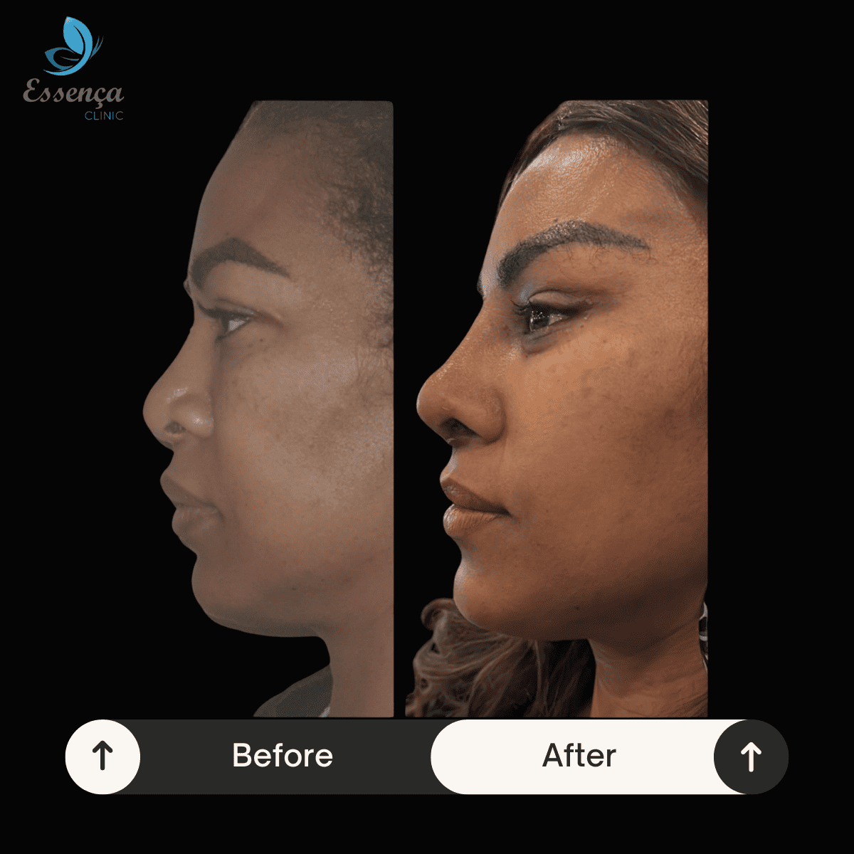 Nose Surgery - Rhinoplasty (24)