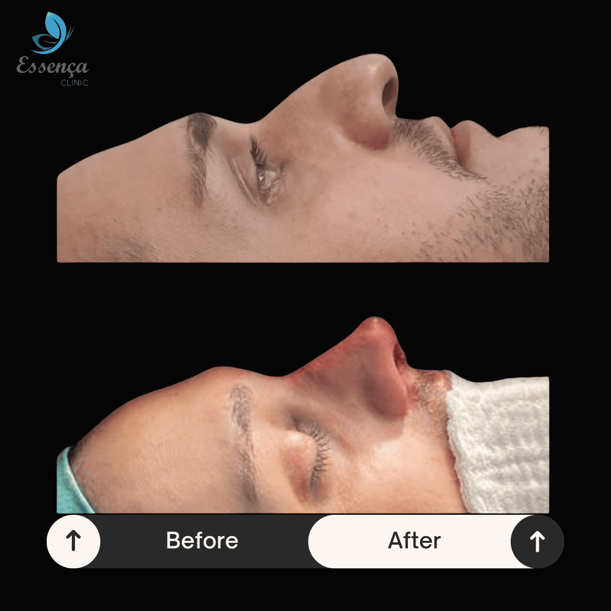 Nose Surgery - Rhinoplasty (25)