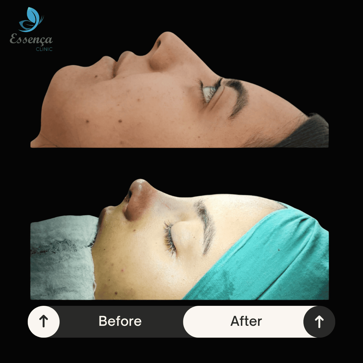 Nose Surgery - Rhinoplasty (27)