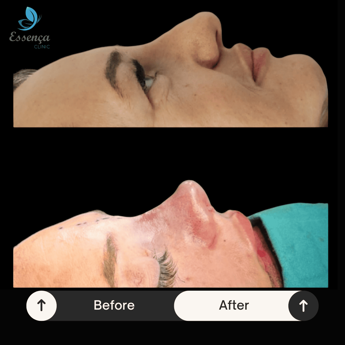 Nose Surgery - Rhinoplasty (28)