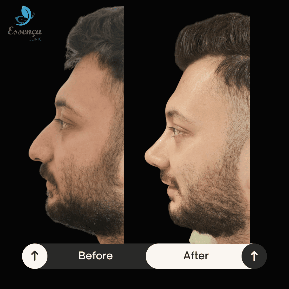 Nose Surgery - Rhinoplasty (29)