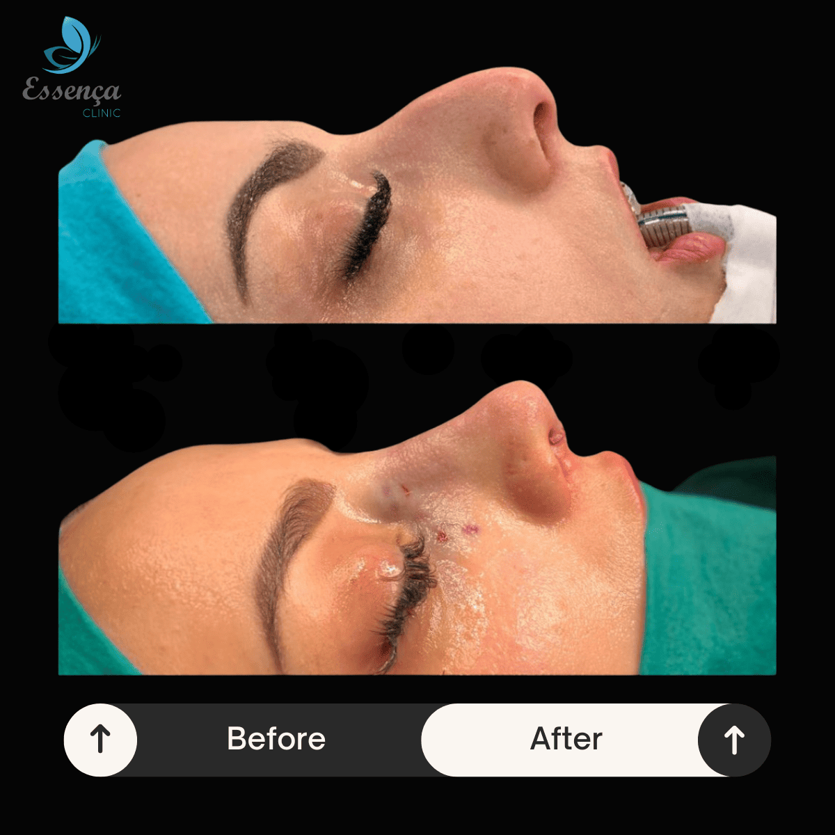 Nose Surgery - Rhinoplasty (3)