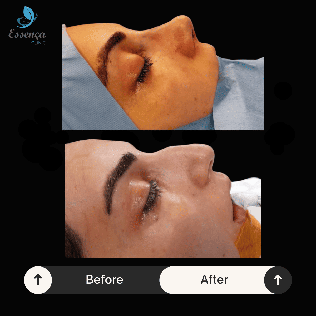 Nose Surgery - Rhinoplasty (4)