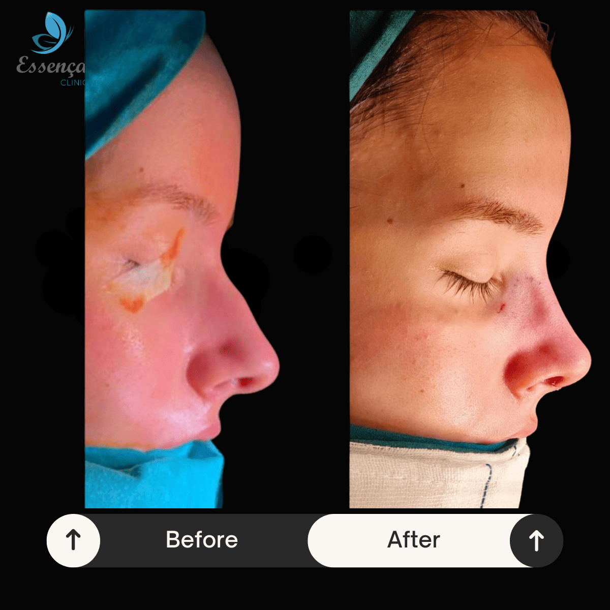 Nose Surgery - Rhinoplasty (5)
