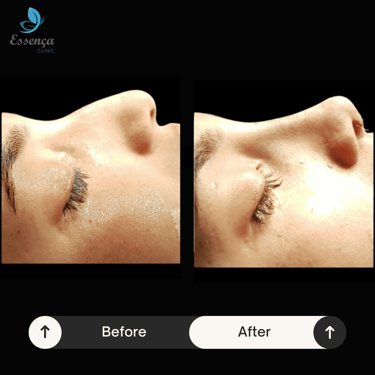 Nose Surgery - Rhinoplasty (6)
