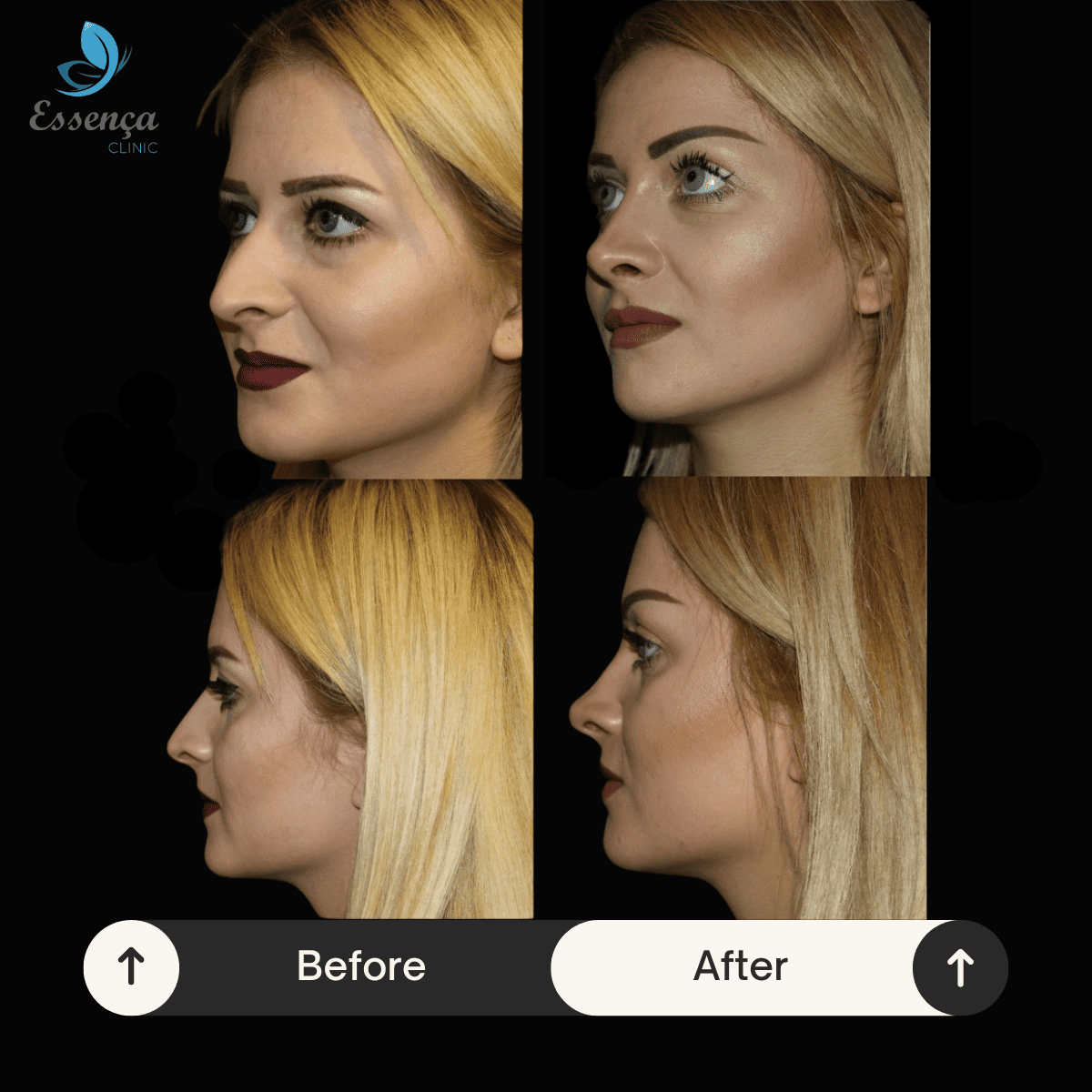 Nose Surgery - Rhinoplasty (7)