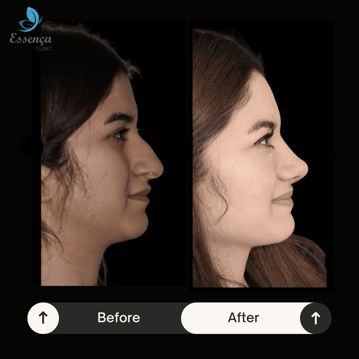 Nose Surgery - Rhinoplasty (8)
