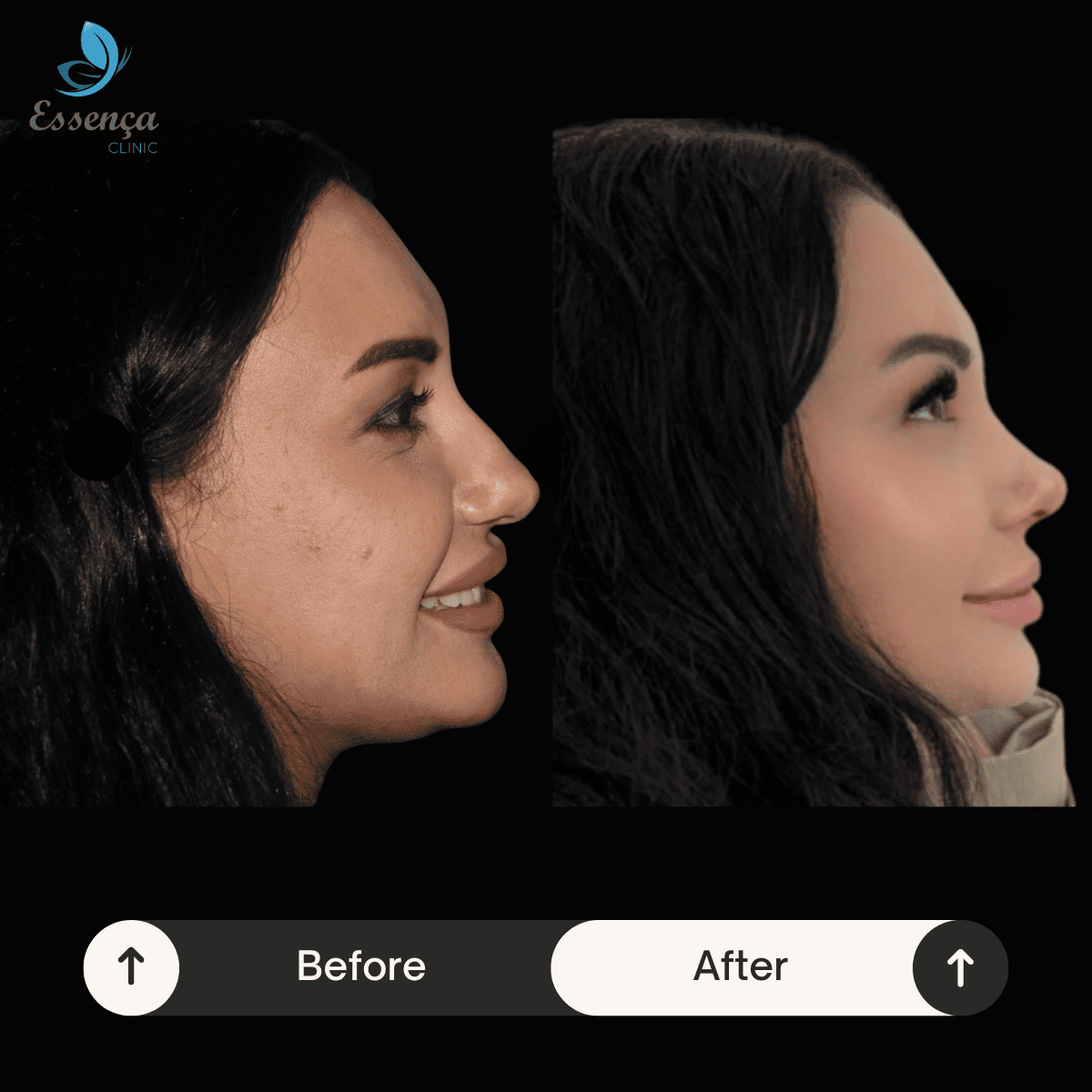 Nose Surgery - Rhinoplasty (9)