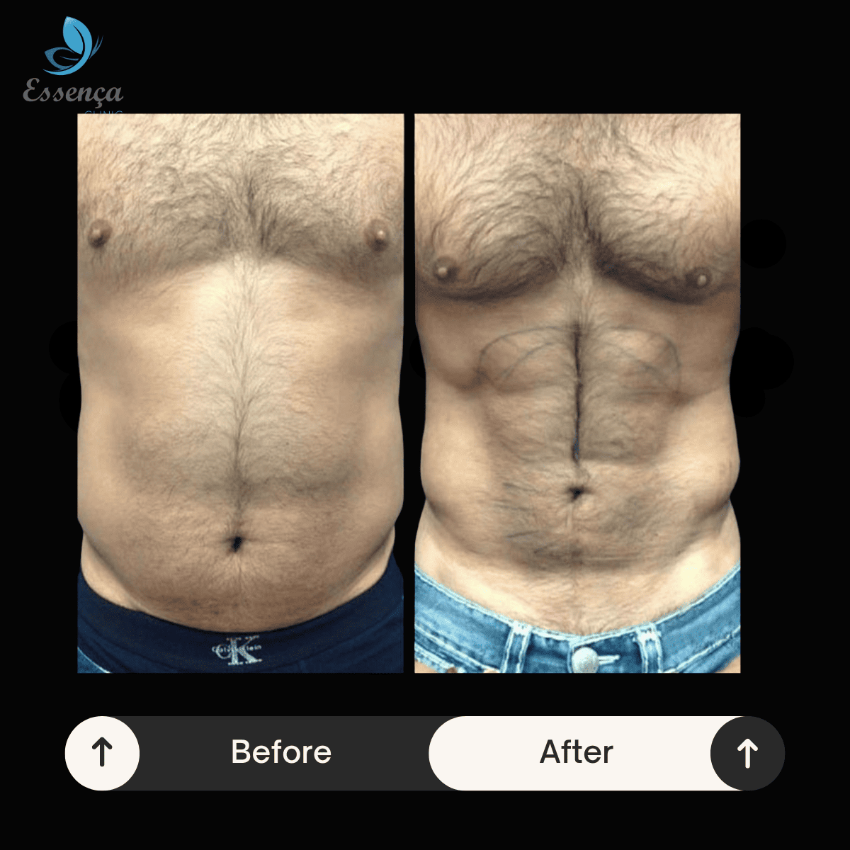 Six Packs Surgery (1)