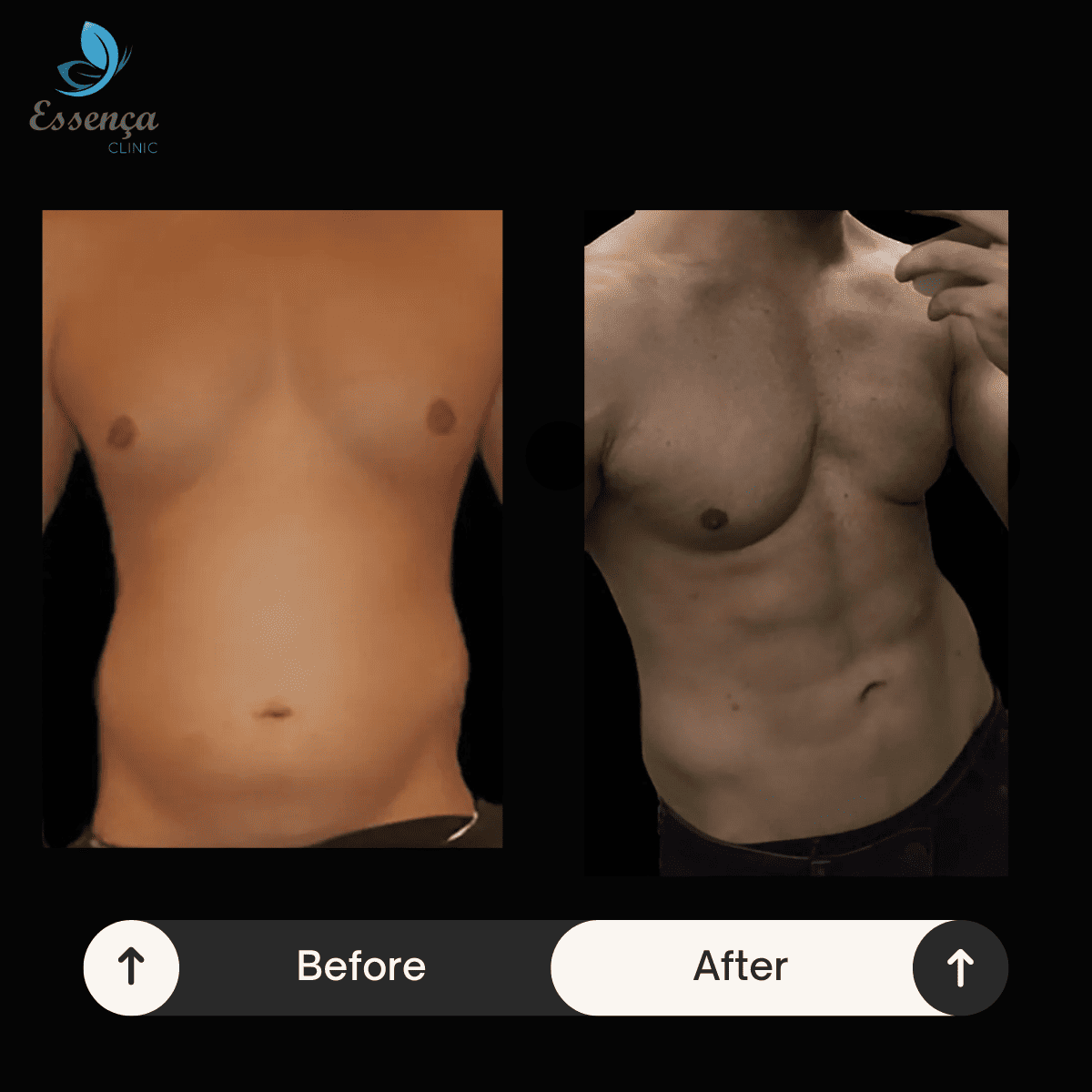 Six Packs Surgery (2)