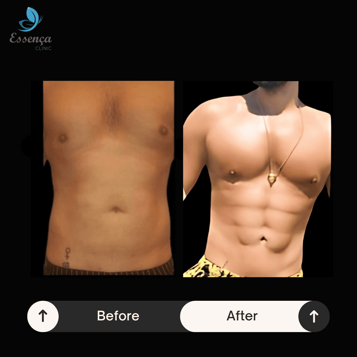 Six Packs Surgery (5)
