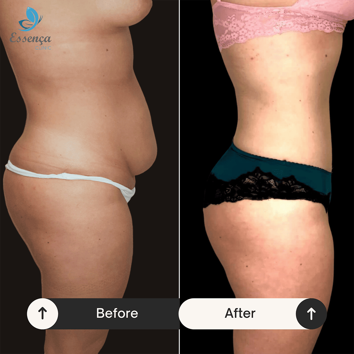 Tummy Tuck - Abdominoplasty (1)