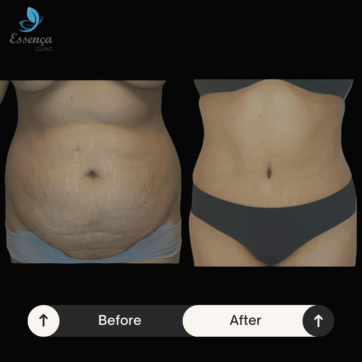 Tummy Tuck - Abdominoplasty (2)