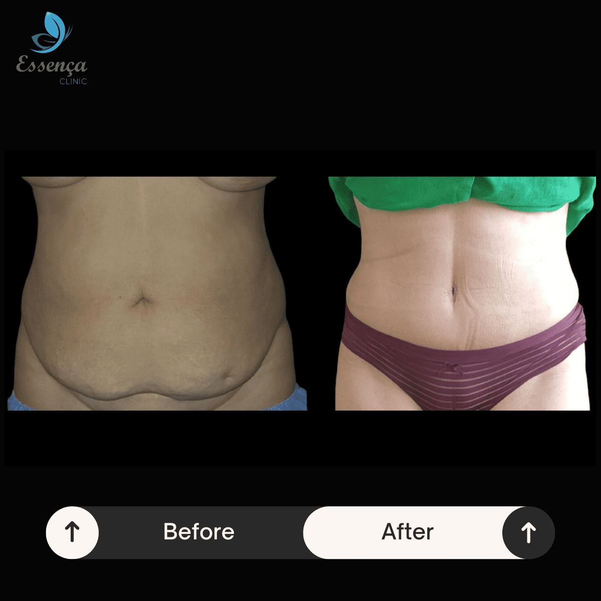 Tummy Tuck - Abdominoplasty (3)