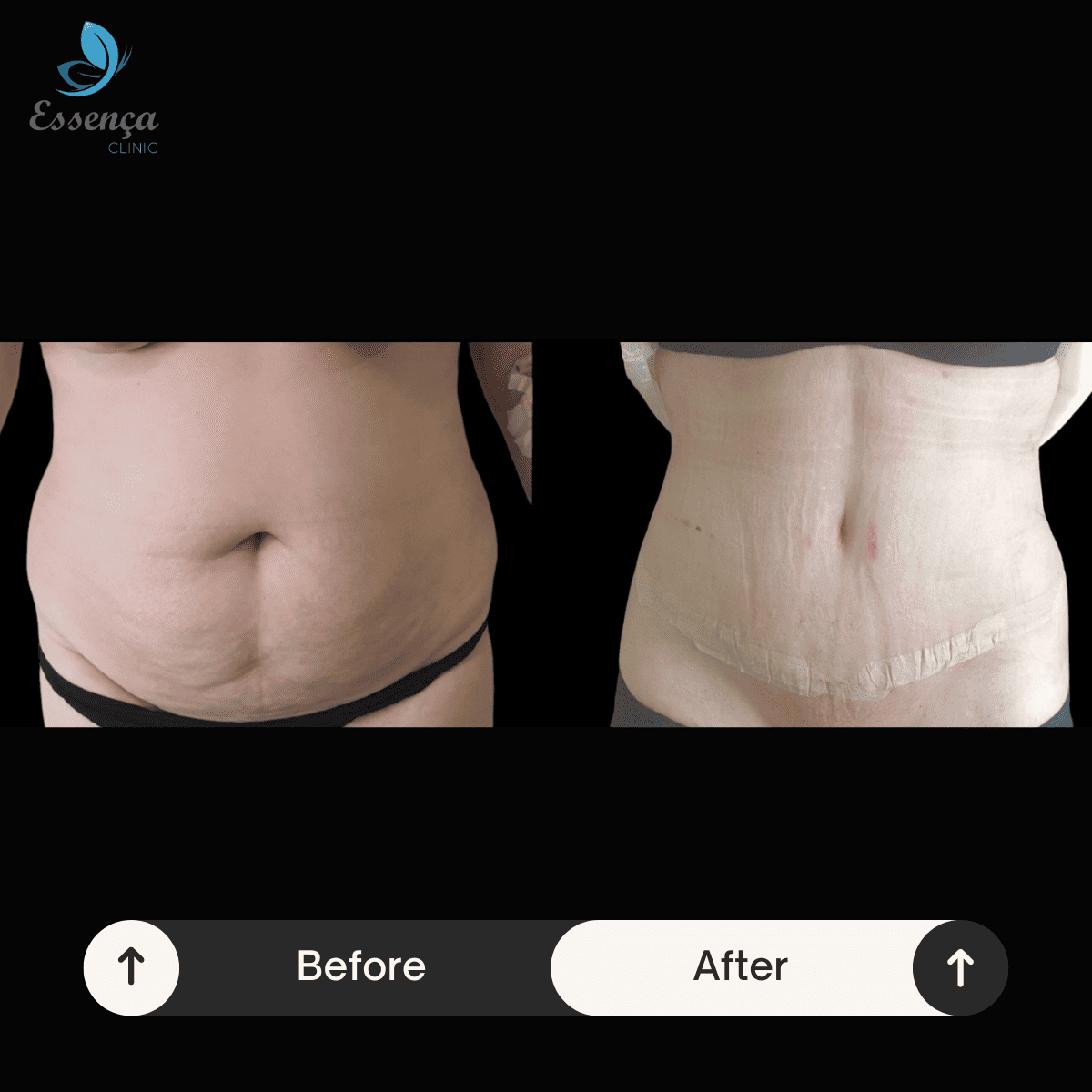 Tummy Tuck - Abdominoplasty (4)