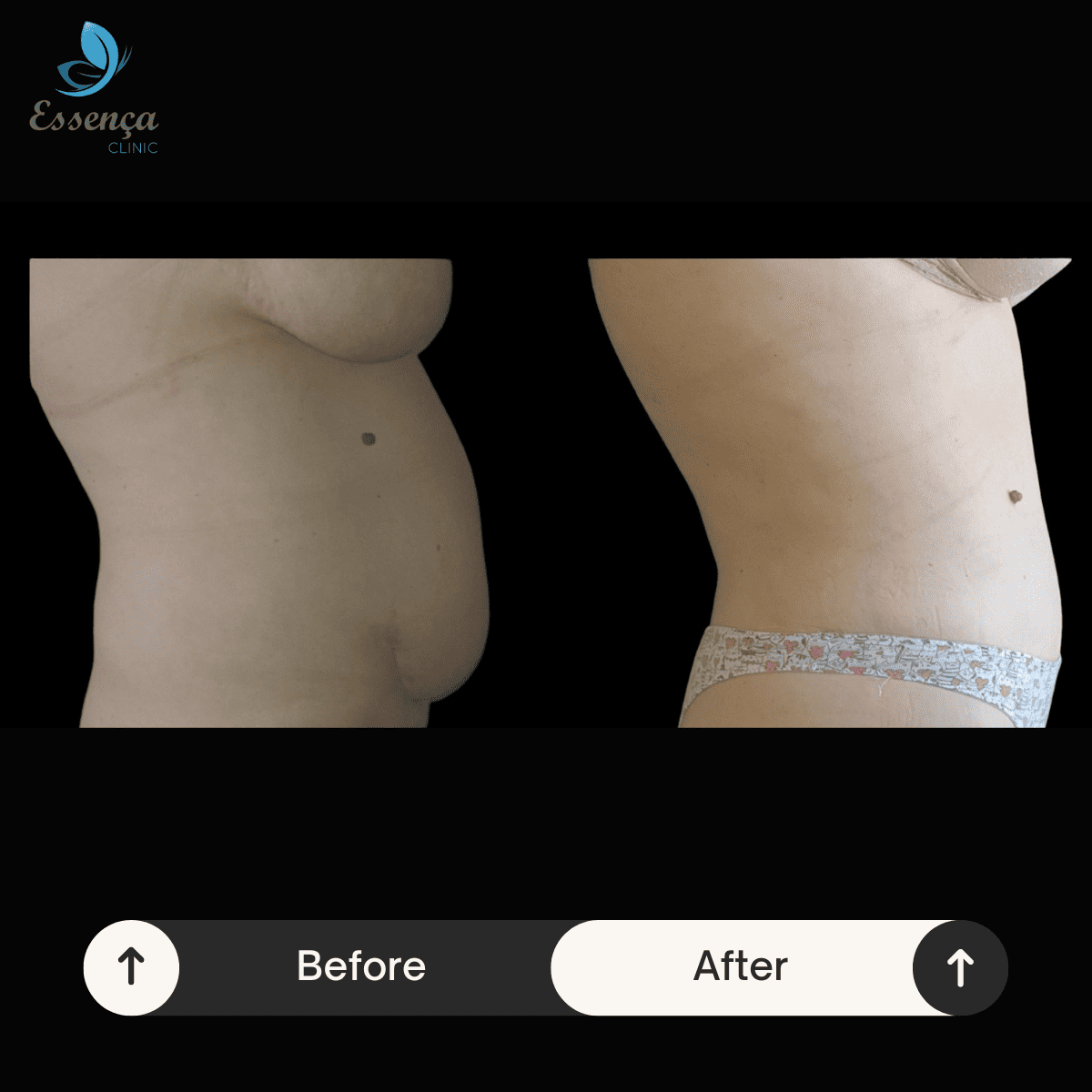 Tummy Tuck - Abdominoplasty (5)