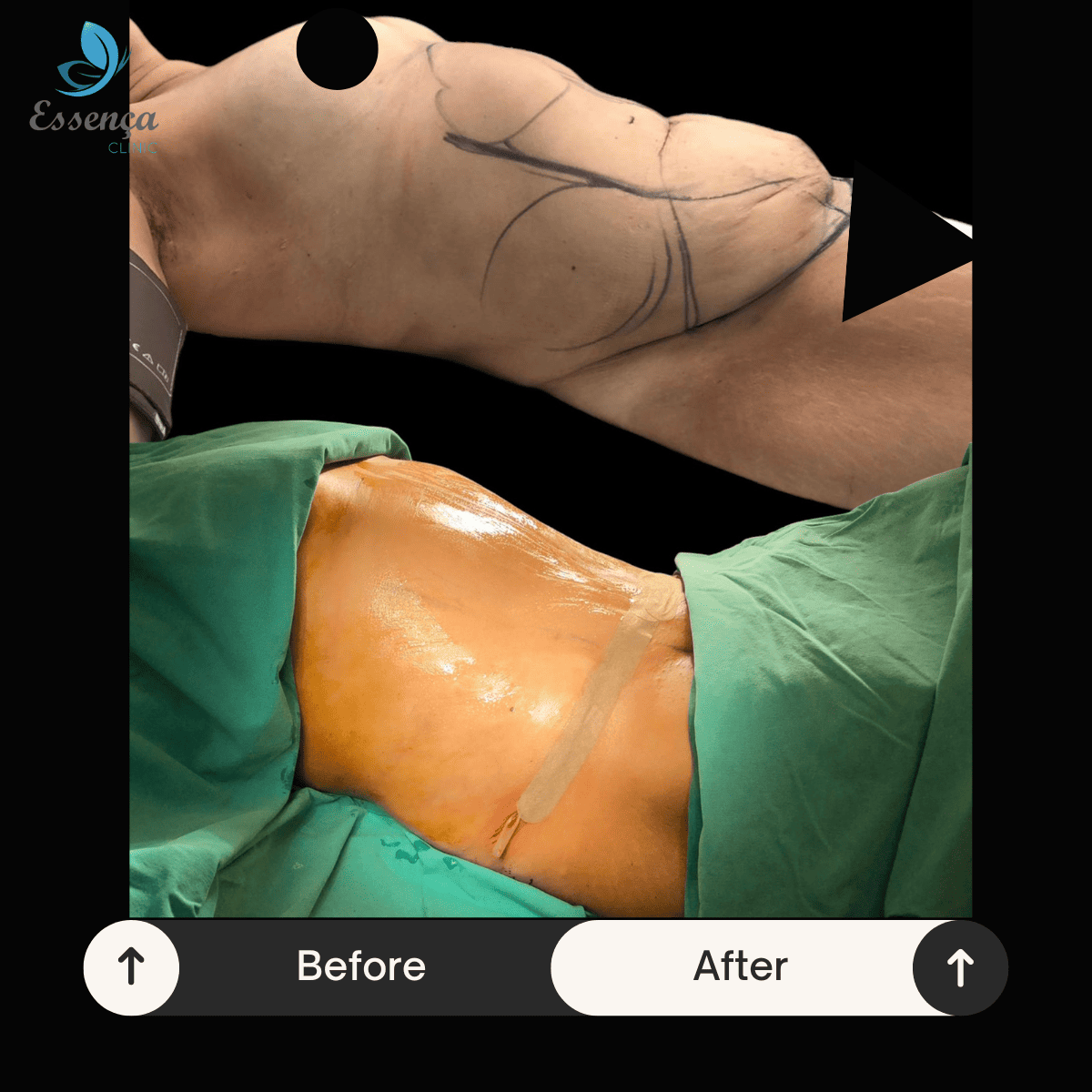 Tummy Tuck - Abdominoplasty (7)