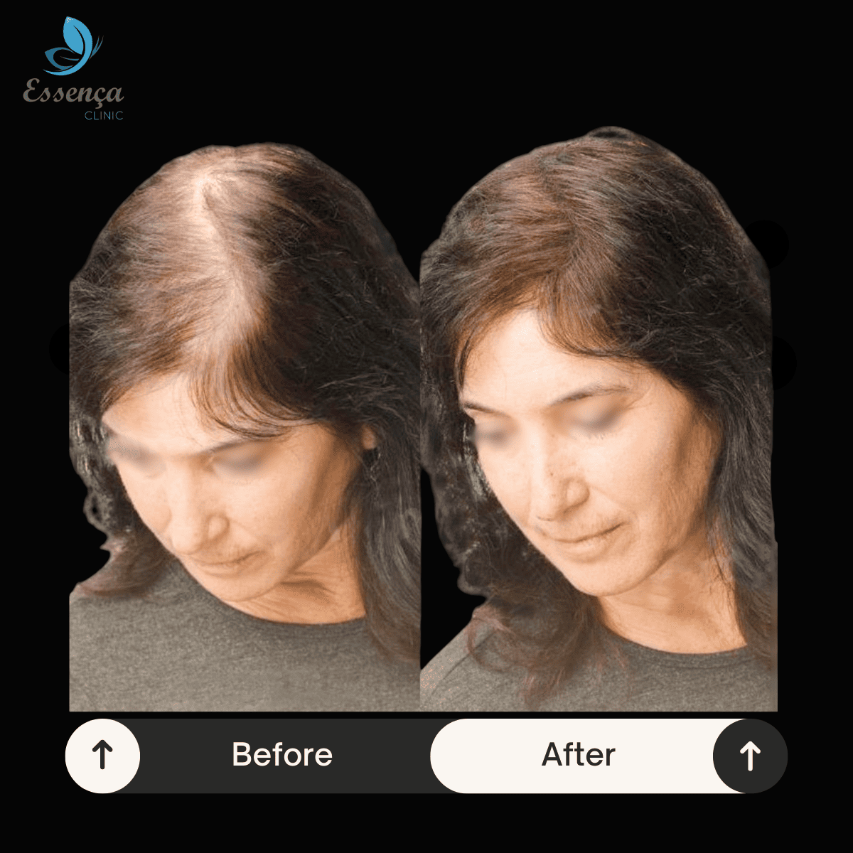 Women Hair Transplant (1)