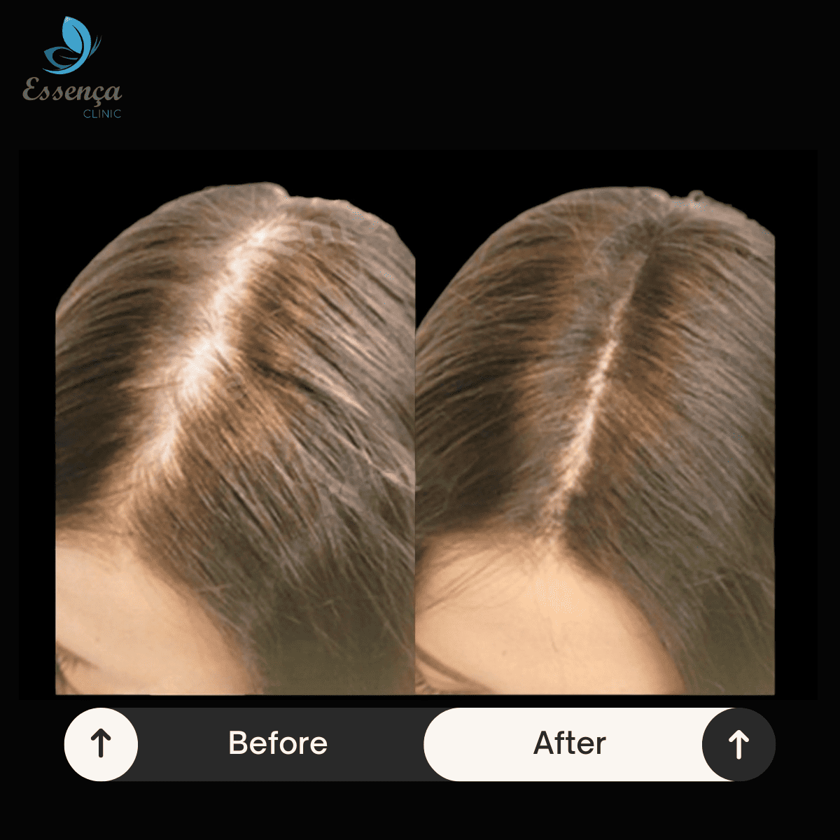 Women Hair Transplant (2)