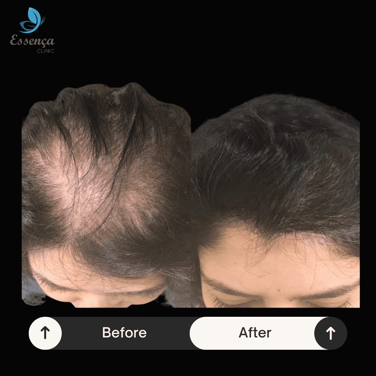 Women Hair Transplant (3)
