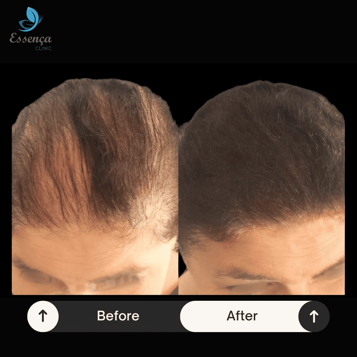 Women Hair Transplant (4)