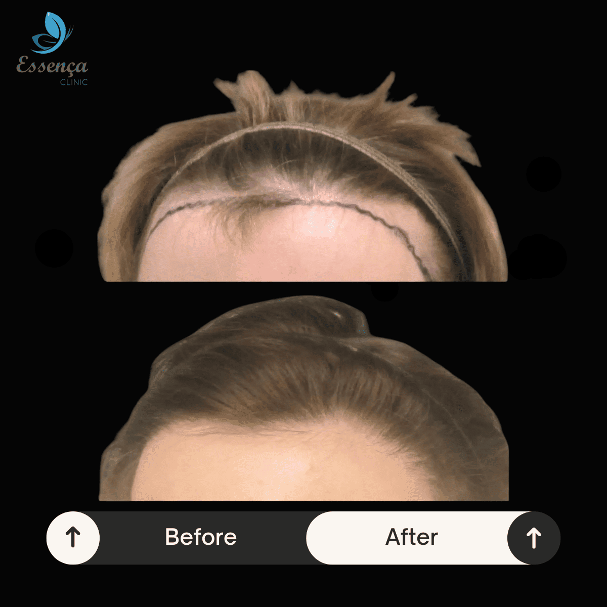 Women Hair Transplant (5)