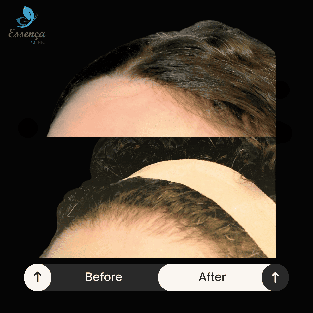 Women Hair Transplant (6)