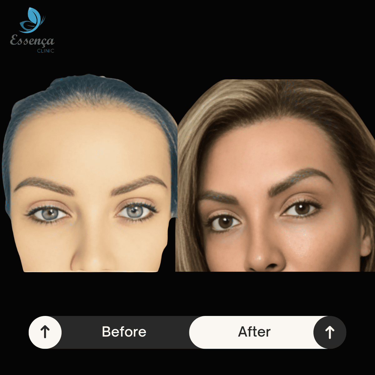 Women Hair Transplant (8)