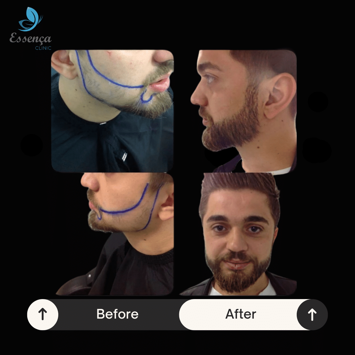 Untitled design 2025 02 04T160652.619 Greffe de Barbe